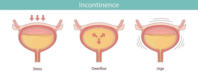 Urinary Incontinence