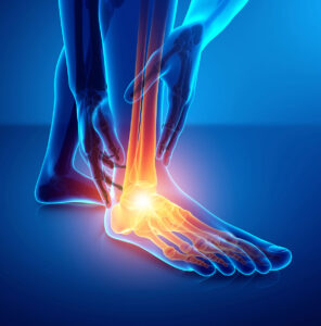 Tibialis Posterior Tendon Dysfunction