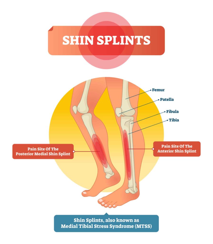 Spin Splints