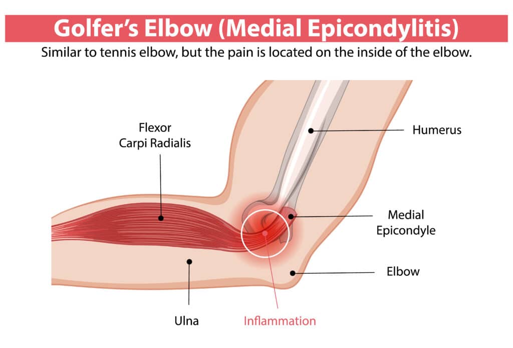 Golfer's Elbow
