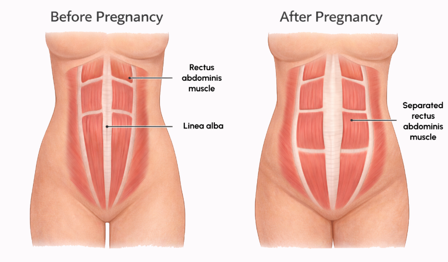 Diastasis Recti