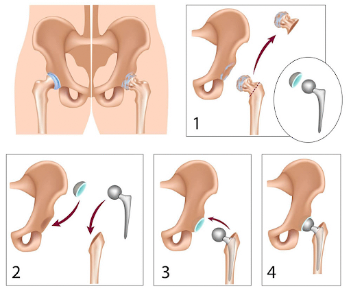 Hip Replacement 