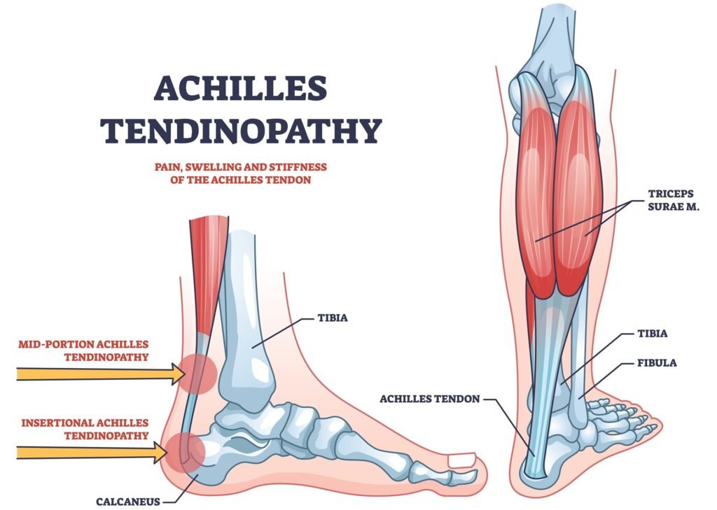 Achilles Tendonitis