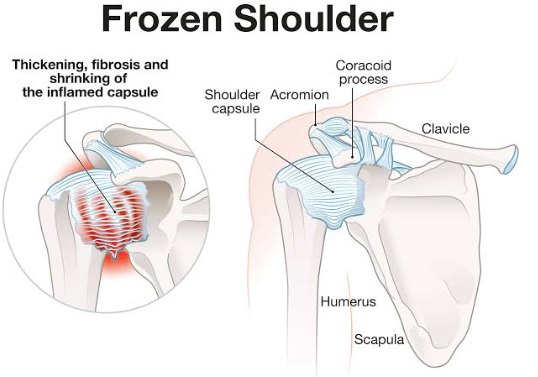 Frozen Shoulder