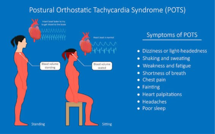 Ehlers Danlos Syndrome (EDS)